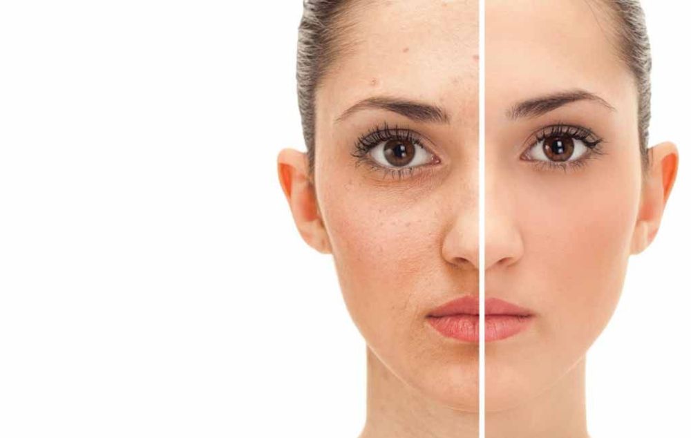 Фитиновый пилинг