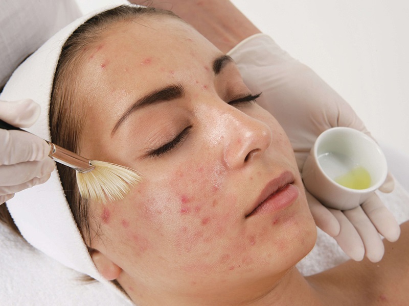 Как избавиться от постакне?