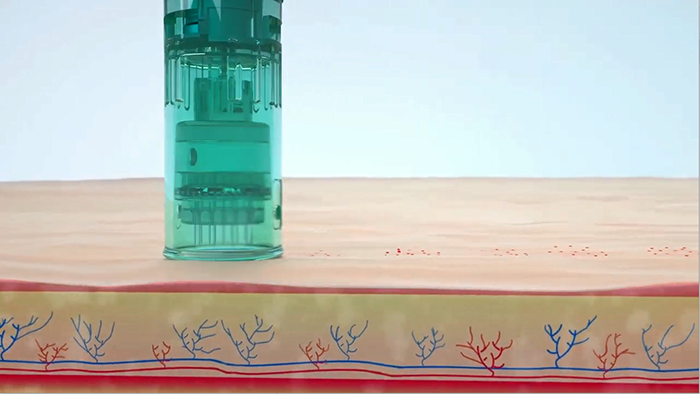 Мезотерапия дермапеном. Стоит ли покупать аппарат?