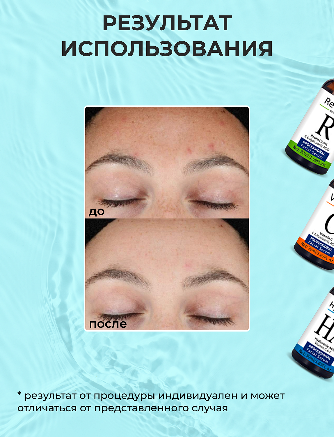 Mezonica Face serum set (Hyaluronic Acid + Vitamin C + Retinol 2,5%) Сыворотка для лица 3-х видов, 30 мл х 3 шт