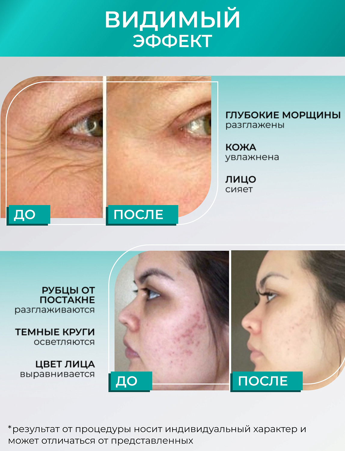 Dr.pen A6s Аппарат для фракционного микроштампинга / электрический массажер для лица / дермапен A6s
